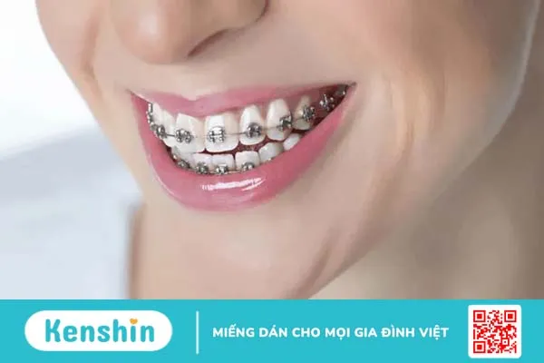 Niềng răng móm có đau không? Gương mặt bạn được cải thiện thế nào?