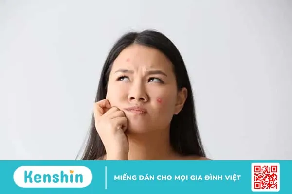 Nỗi khổ mắc mụn trứng cá dạng nang ở người trưởng thành