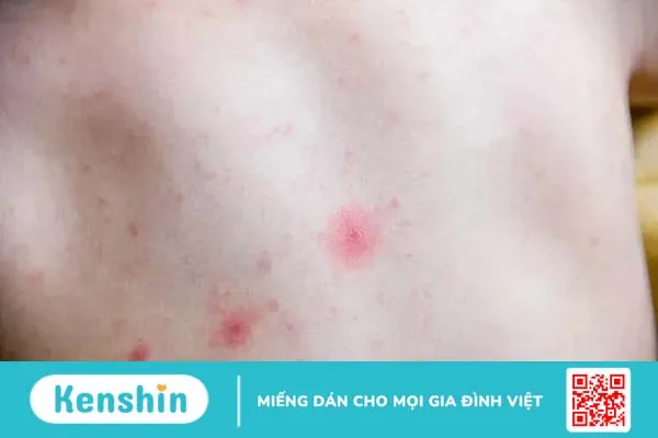 Nổi mẩn đỏ ngứa như muỗi đốt – Triệu chứng, nguyên nhân và cách xử lý