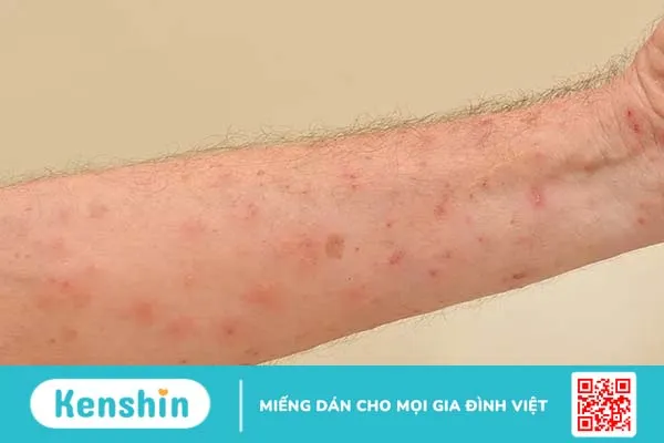 Nổi mẩn đỏ ngứa như muỗi đốt – Triệu chứng, nguyên nhân và cách xử lý