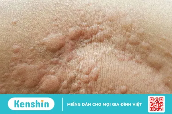 Nổi mề đay: Nguyên nhân do đâu và cách điều trị