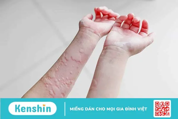 Nổi mề đay: Nguyên nhân do đâu và cách điều trị