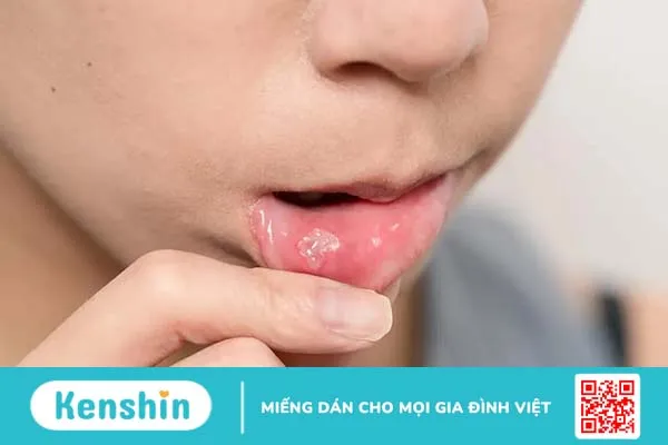 Nổi mụn trong miệng là dấu hiệu của bệnh gì?