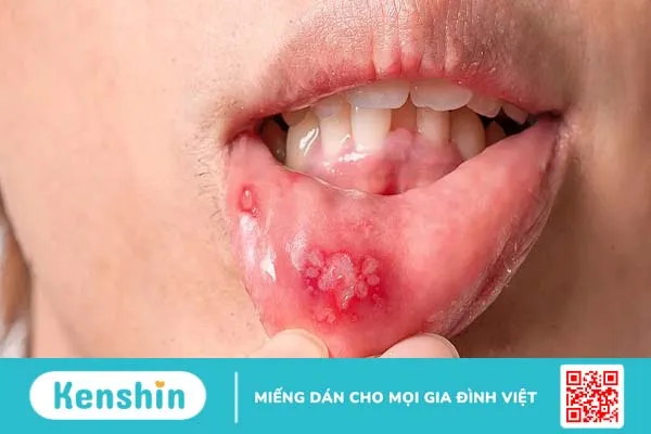 Nổi mụn trong miệng là dấu hiệu của bệnh gì?