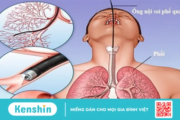 Nội soi phổi có nguy hiểm không và những rủi ro có thể xảy ra