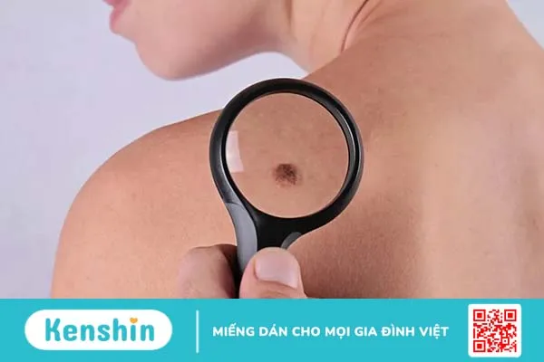 Nốt ruồi báo ung thư có đặc điểm gì và cách điều trị