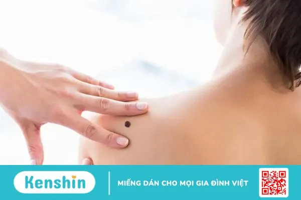 Nốt ruồi bị ngứa: Khi nào cảnh báo ung thư da?