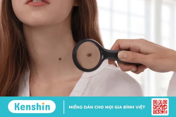 Nốt ruồi và tàn nhang – Những điểm khác biệt