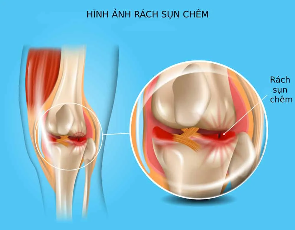 Phân biệt 5 chấn thương đầu gối phổ biến – Thời gian và cách điều trị