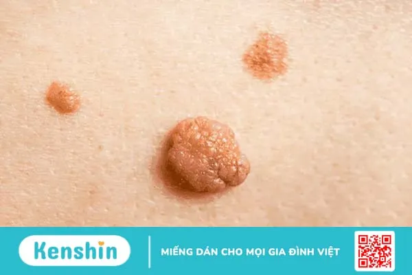 Phân biệt các loại mụn: Cách nhận biết, nguyên nhân & cách điều trị