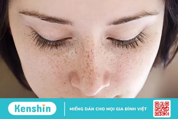 Phân biệt nám da tàn nhang: Đâu là đặc điểm nhận diện?