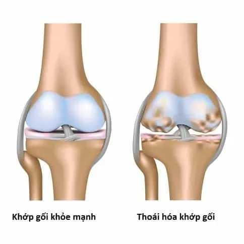 Phân biệt thoái hóa khớp gối và loãng xương