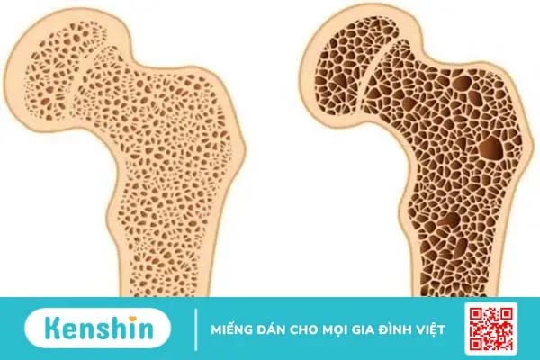 Phân biệt thoái hóa khớp gối và loãng xương