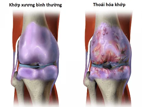 Phân biệt thoái hóa khớp và thoát vị đĩa đệm