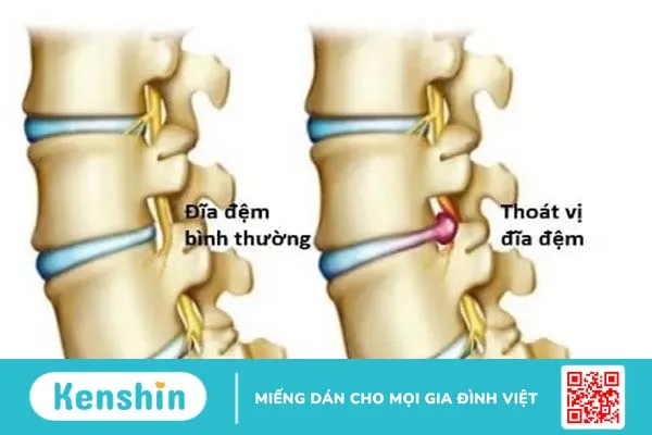 Phân biệt thoái hóa khớp và thoát vị đĩa đệm