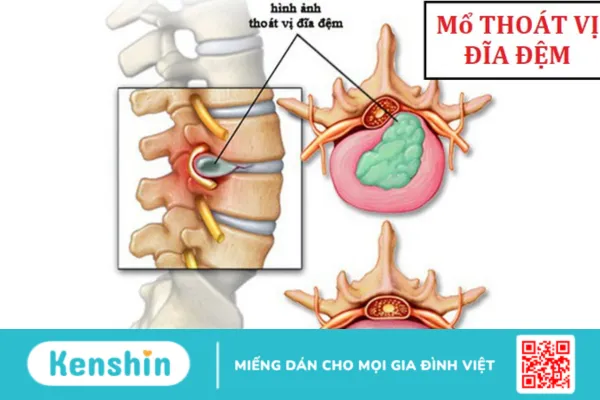 Phẫu thuật cắt bỏ đĩa đệm là gì ? Khi nào thì cần thực hiện phẫu thuật ?