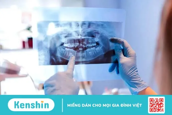 Phẫu thuật hàm móm: Đừng bỏ qua những thông tin sau