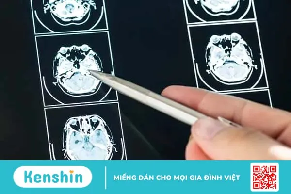 Phẫu thuật tai biến mạch máu não và những điều cần biết