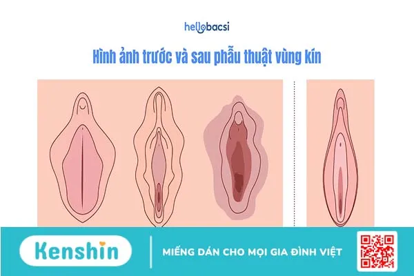 Phẫu thuật thẩm mỹ vùng kín – Những điều bạn cần phải biết!