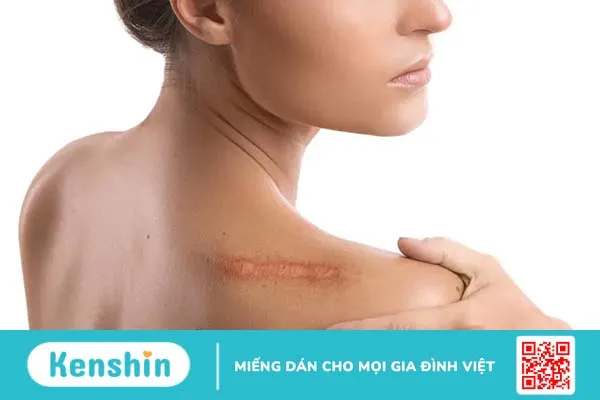 Phẫu thuật thẩm mỹ xóa sẹo và những điều bạn cần biết