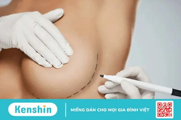 Phẫu thuật ung thư vú: Tái tạo vú với túi độn và vạt ghép mô tự thân