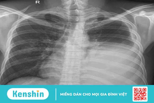 Phổi bị trắng là bệnh gì? Có nguy hiểm không?