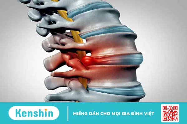 Phồng đĩa đệm là gì? Cách chữa phồng đĩa đệm