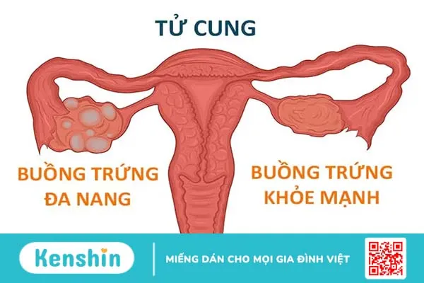 Phụ nữ bị buồng trứng đa nang có nên uống sữa đậu nành?