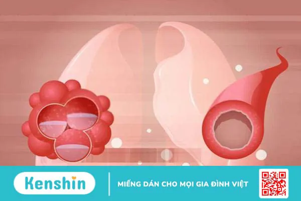 Phù phổi cấp – Nguy hiểm đến tính mạng, nhưng có thể phòng ngừa