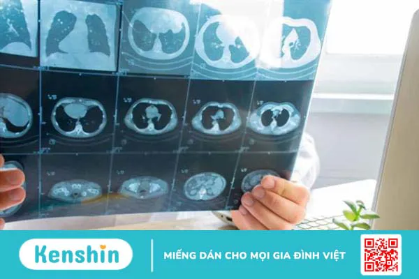 Phù phổi cấp – Nguy hiểm đến tính mạng, nhưng có thể phòng ngừa