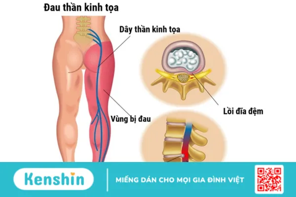 Phương pháp điều trị đau dây thần kinh tọa hiệu quả