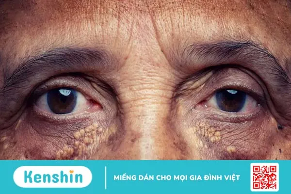 Quy trình và tiêu chuẩn chẩn đoán rối loạn lipid máu