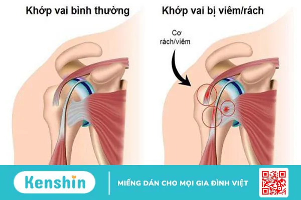 Rách chóp xoay khớp vai