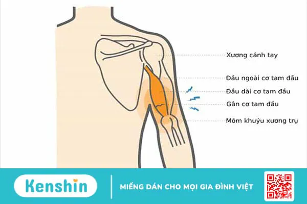 Nguyên nhân dẫn đến rách cơ tam đầu cánh tay và cách khắc phục