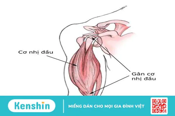 Rách gân cơ nhị đầu