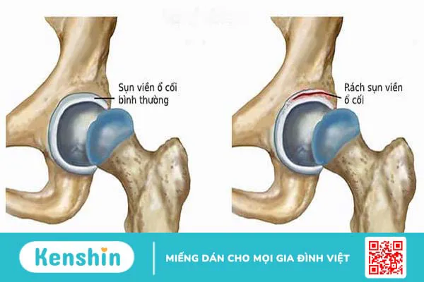 Rách sụn viền ổ cối