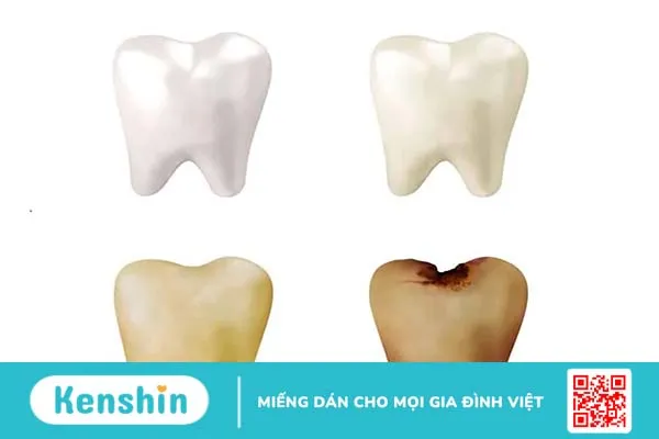 Răng bị mục: Nguyên nhân, dấu hiệu và phương pháp điều trị