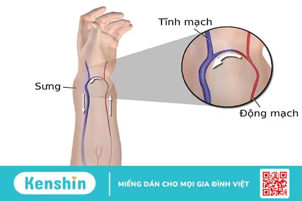 Rò động tĩnh mạch