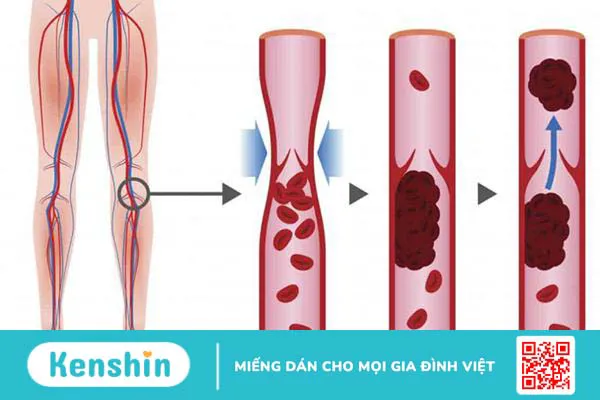 Rủi ro của phẫu thuật thay khớp gối, bạn đã biết chưa?