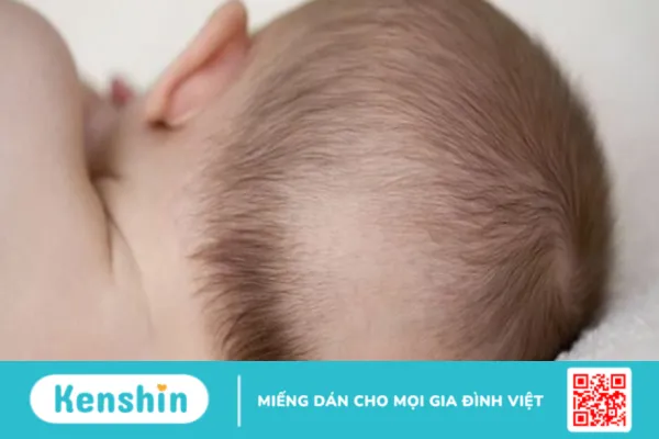 Rụng tóc vành khăn ở trẻ nhỏ là gì, trẻ có nguy cơ hói vĩnh viễn không?