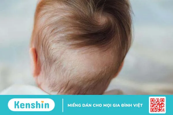 Rụng tóc vành khăn ở trẻ nhỏ là gì, trẻ có nguy cơ hói vĩnh viễn không?