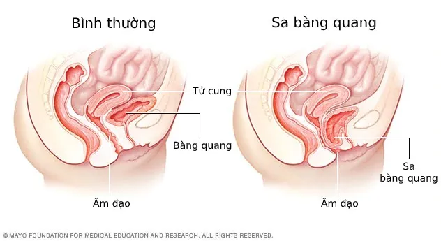 Sa bàng quang