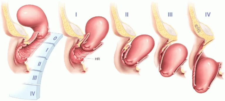 Sa tử cung khi mang thai nguy hiểm ra sao? Có sinh thường được không?