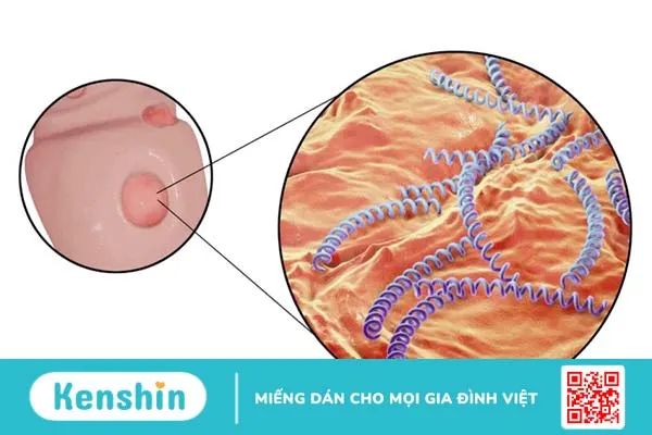 Săng giang mai và mối quan hệ với bệnh giang mai