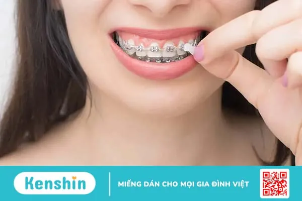 Sáp nha khoa là gì? Dùng sáp chỉnh nha đúng cách, giảm cơn đau hiệu quả