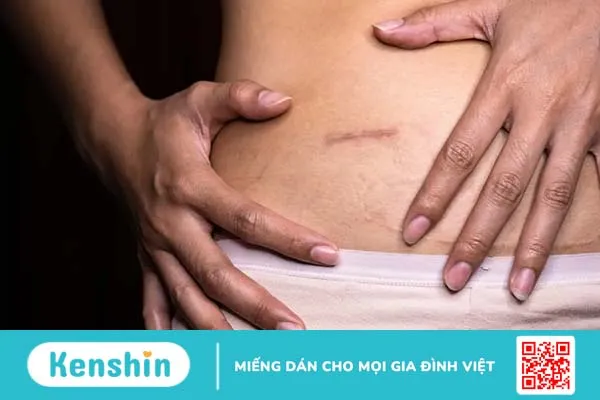 Sau khi mổ ruột thừa bao lâu thì quan hệ được?