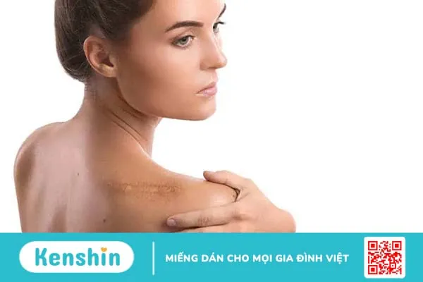 Sẹo lồi và cách ngăn sẹo lồi phát triển