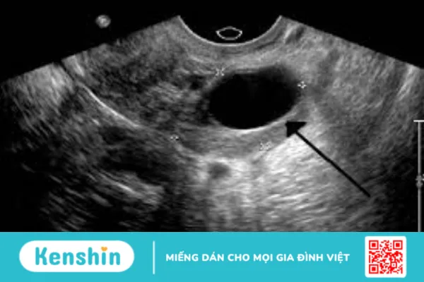 Siêu âm canh trứng tăng cơ hội thụ thai: Bạn cần biết những gì?