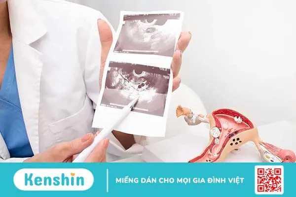 Siêu âm chẩn đoán buồng trứng đa nang là gì? Tiêu chuẩn chẩn đoán ra sao?