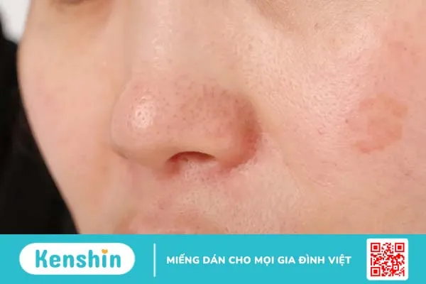 Sợi bã nhờn là gì? Nguyên nhân và cách điều trị sợi bã nhờn